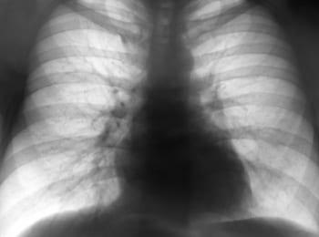 A New Genetic Study on Pneumonia