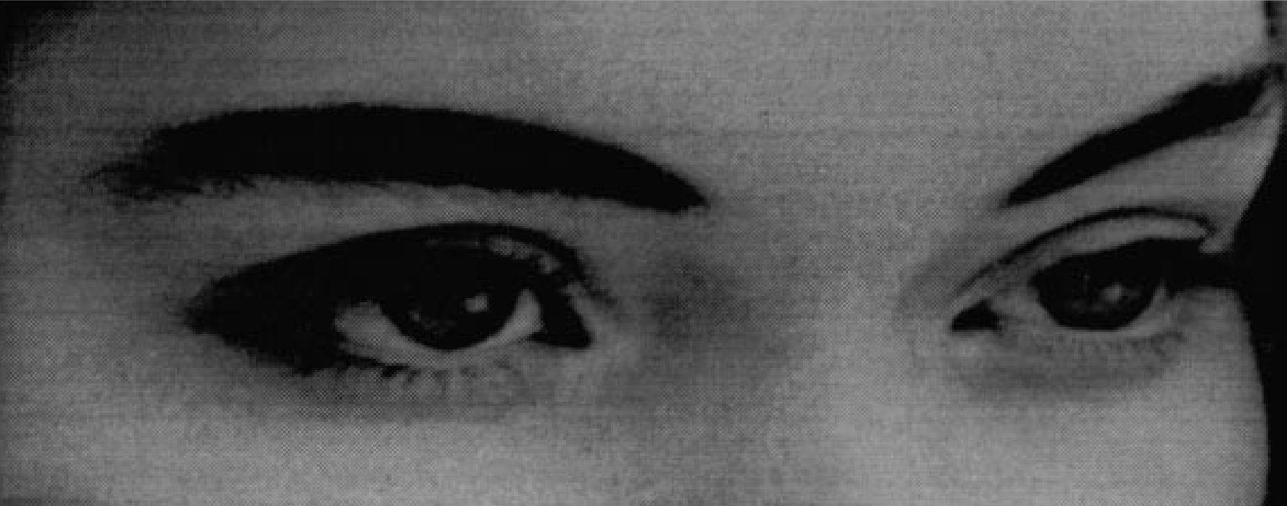 Genetic Study of Cataracts in Puerto Ricans