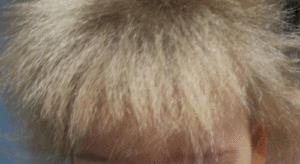 A case of uncombable hair syndrome