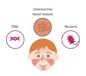 Rosacea causes